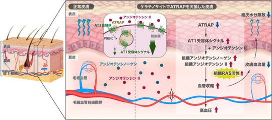 高血圧の新たな発症メカニズムを解明 ー皮膚の微小血管収縮と血圧上昇の関係を明らかにー