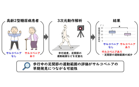 高齢2型糖尿病患者のサルコペニアの早期発見に有用な歩行指標を明らかに　歩行中の足関節の運動範囲がサルコペニアの有無により異なることを発見