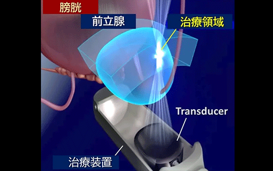 西日本初!先進医療 HIFU(ハイフ)を用いた前立腺がん局所療法を香大病院で開始